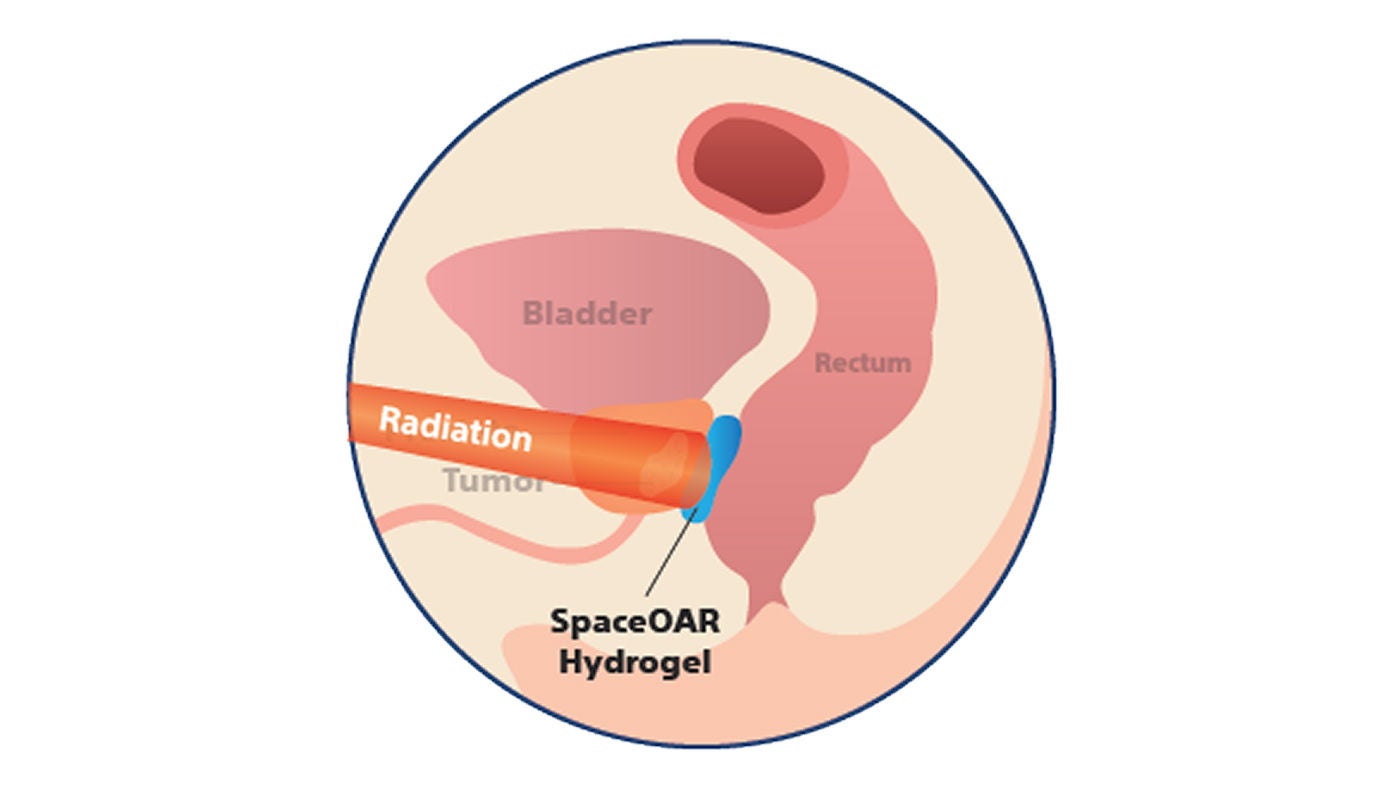 Illustration der Anatomie einer Prostata während Bestrahlung mit Hydrogel-Spacer