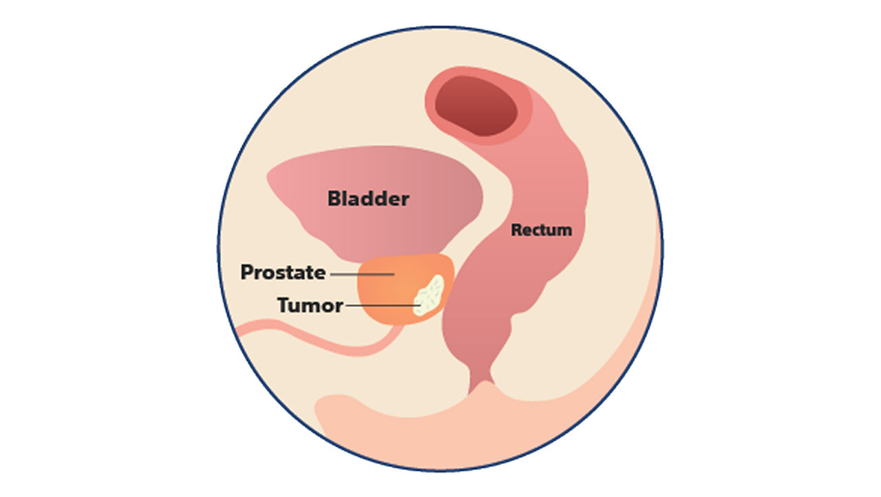 Illustration der Anatomie einer Prostata ohne Hydrogel-Spacer