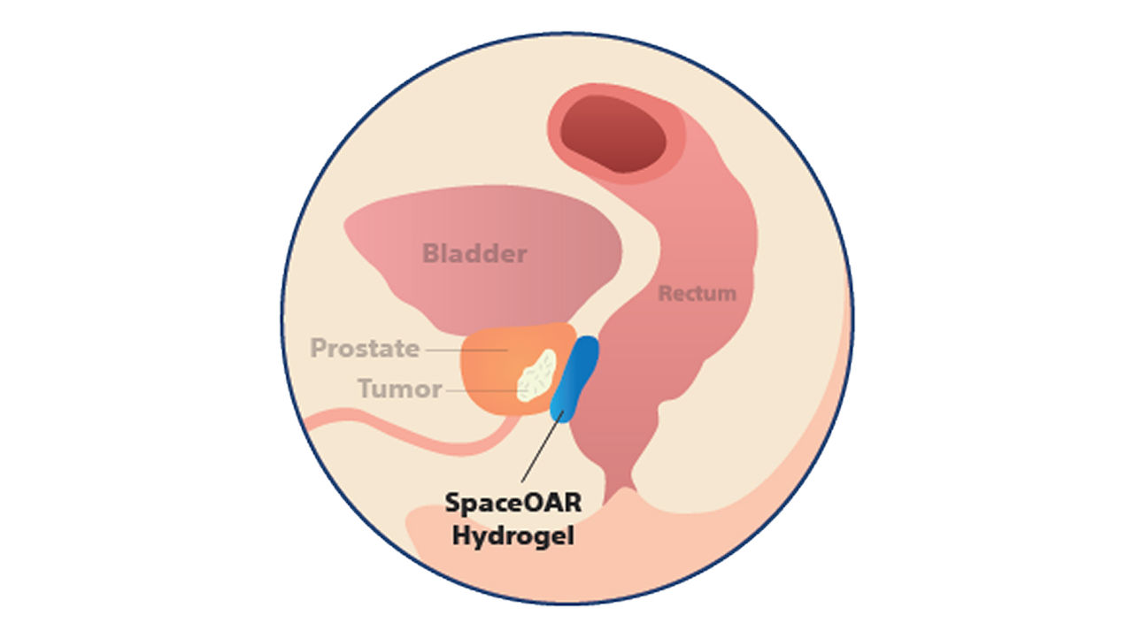 Illustration der Anatomie einer durch Hydrogel-Spacer geschützten Prostata