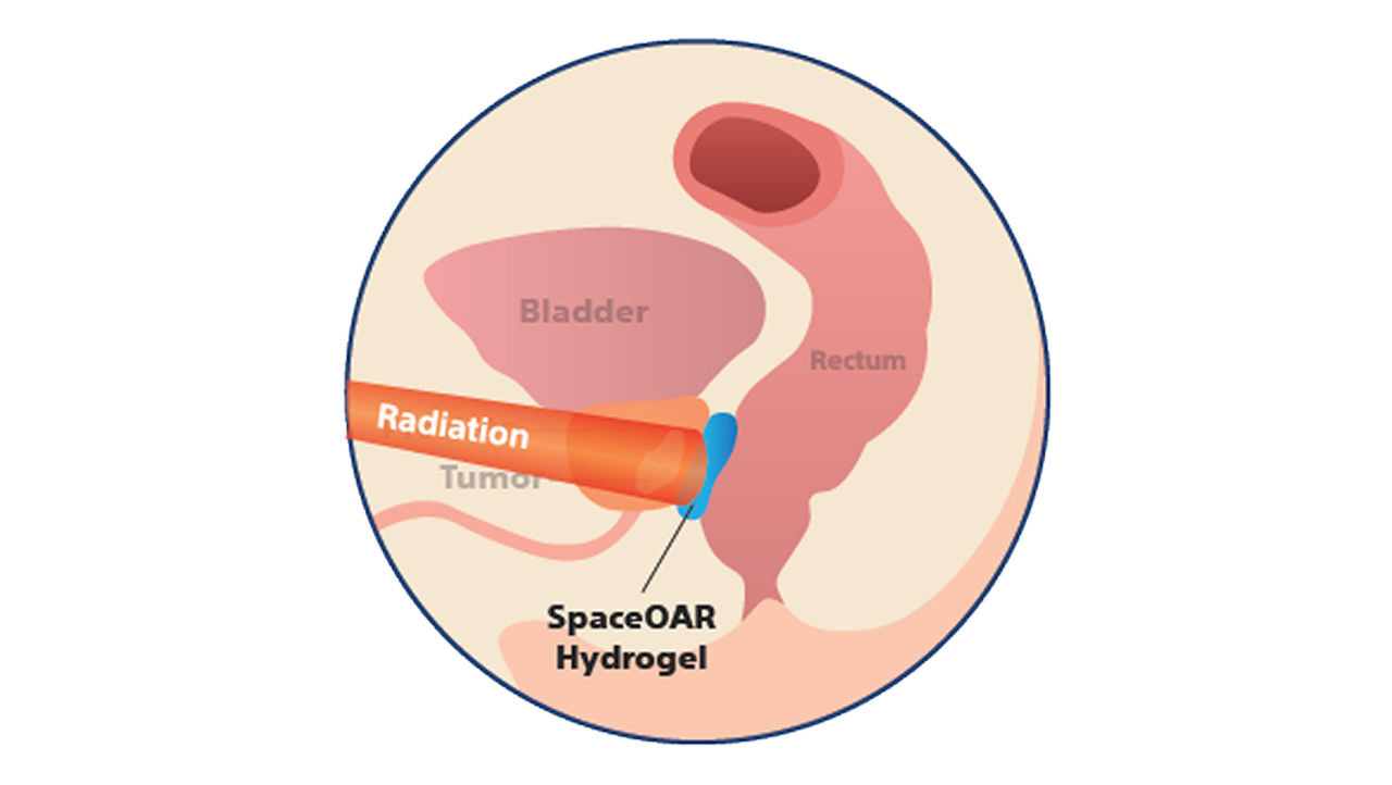 Illustration der Anatomie einer Prostata während Bestrahlung mit Hydrogel-Spacer